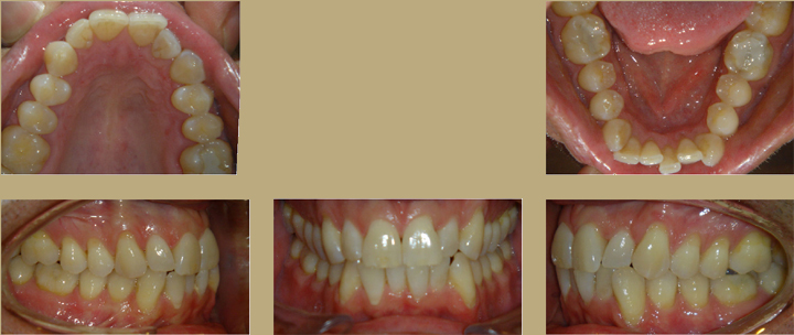 Invisalign 1