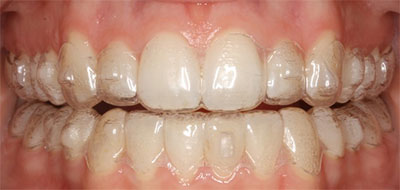 clear braces